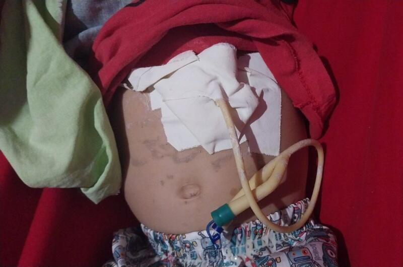 Enquanto isso, ele se alimenta por uma sonda provisória - Foto: Arquivo pessoal