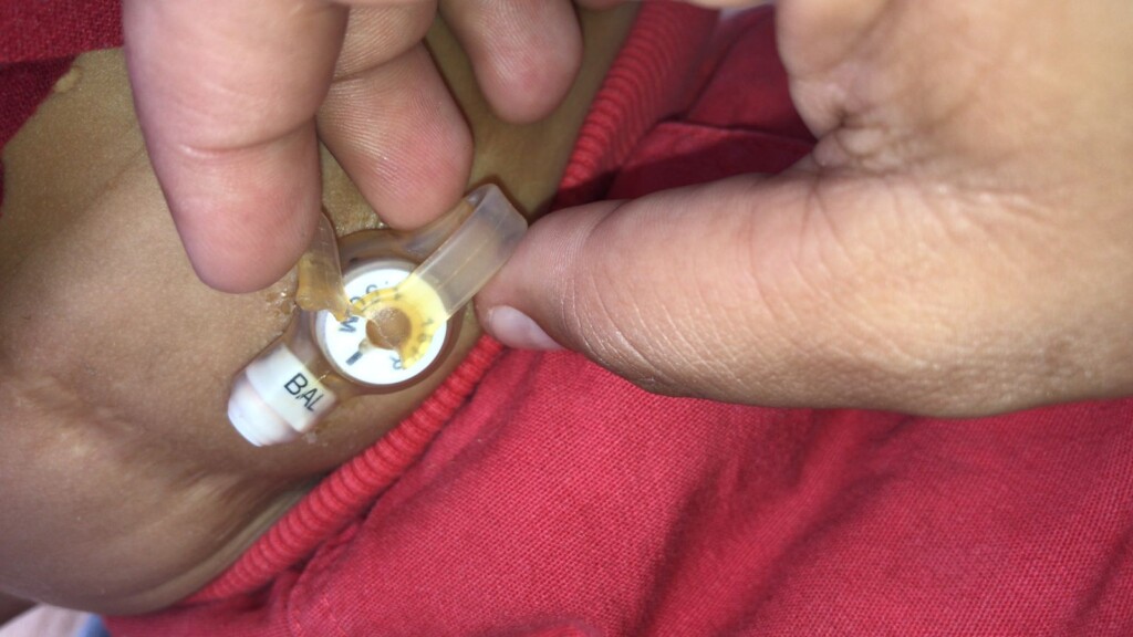 Criança de dois anos precisa de ajuda para compra de nova sonda de alimentação Criança de dois anos precisa de ajuda para compra de nova sonda de alimentação