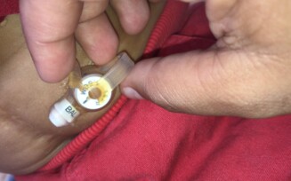 Criança de dois anos precisa de ajuda para compra de nova sonda de alimentação