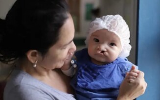A fissura labiopalatina é uma condição congênita que afeta a formação do lábio e do palato (Foto: Divulgação)