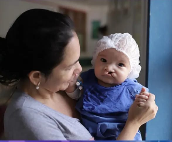 A fissura labiopalatina é uma condição congênita que afeta a formação do lábio e do palato (Foto: Divulgação)