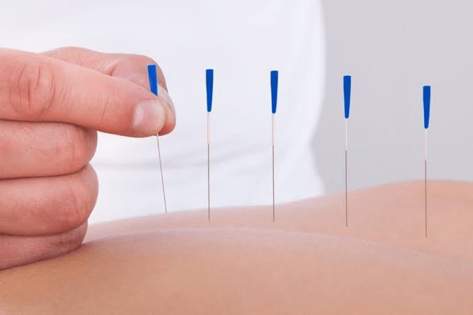 Acupuntura pode complementar tratamento de fibromialgia