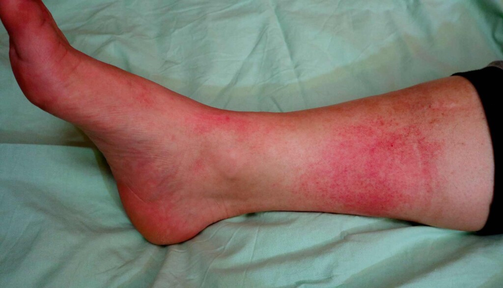Celulite infeccionas pode levar ao óbito em dois dias, afirma infectologista Celulite infeccionas pode levar ao óbito em dois dias, afirma infectologista